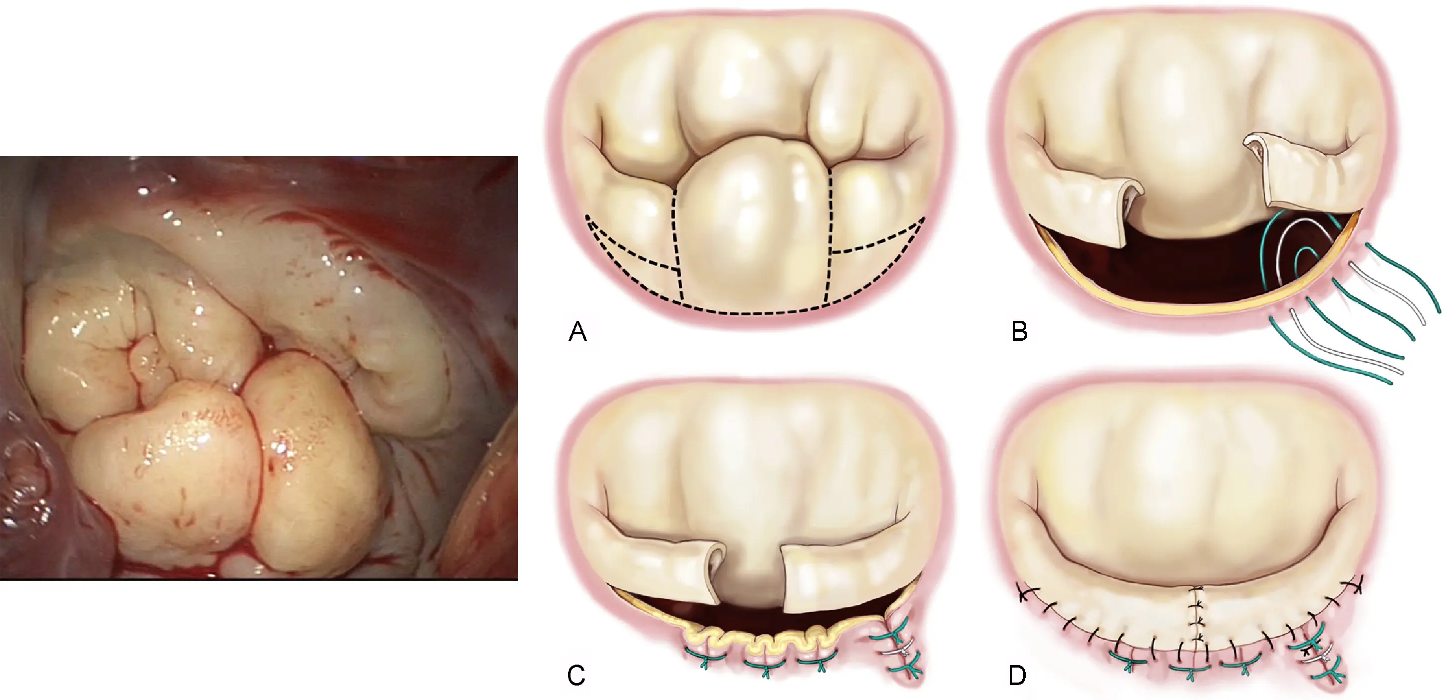 Barlow Sendromu: Hangi Durumlarda Ameliyat Gerekir?