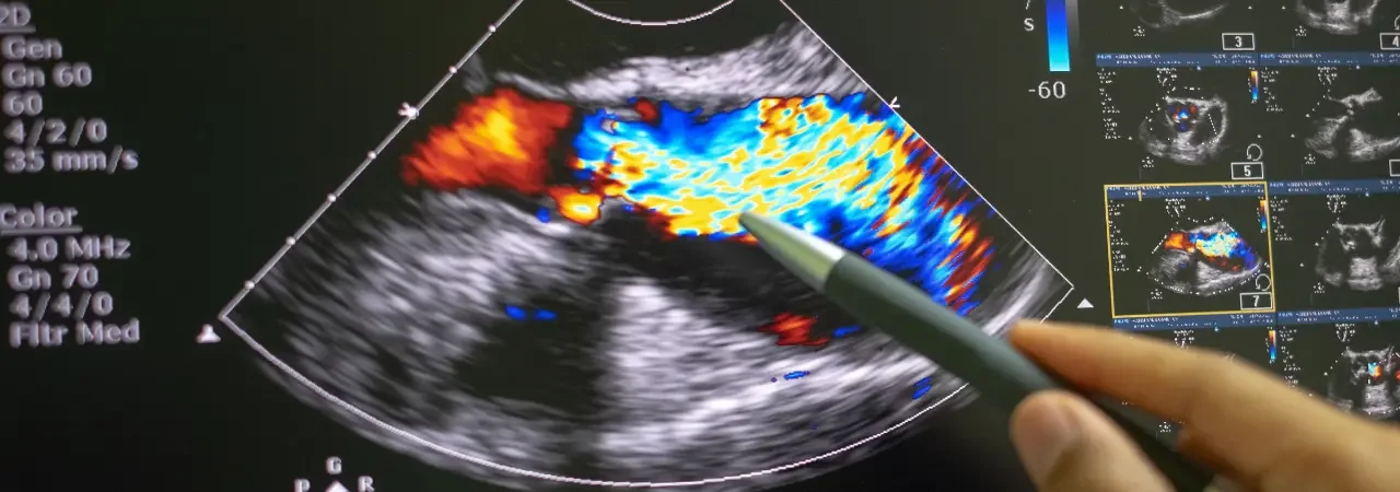 Bilgisayarlı Tomografi | Kalp Damarlarının Kesitsel Görüntülenmesi