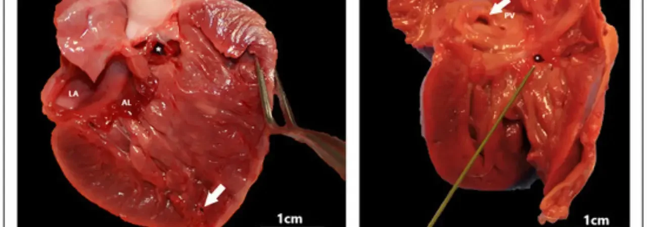 Ventriküler Septal Defekt Nedir? Semptomlar ve Tedavi Seçenekleri