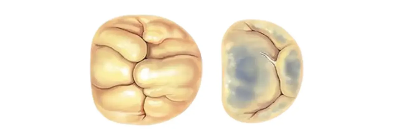 Barlow Sendromu: Nedenleri ve Tedavi Yöntemleri