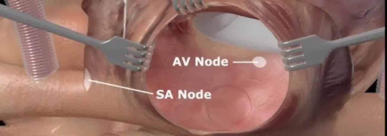 Maze Ameliyatı Sonrası İyileşme Süreci