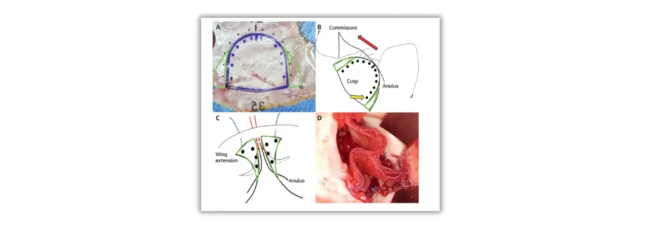 Özaki Yöntemi Nedir? Kimlere Uygulanır?