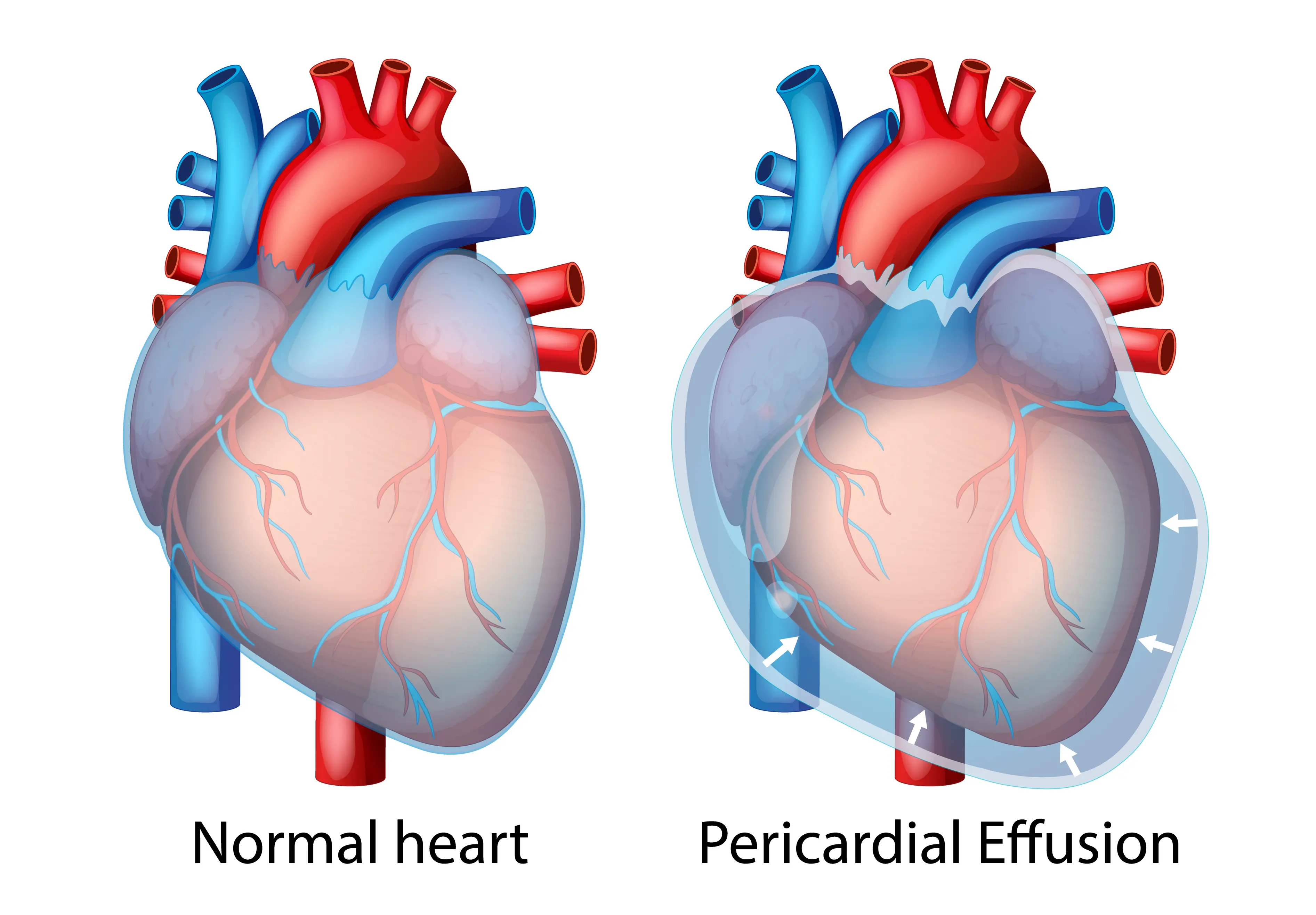 Perikardiyal Efüzyon: Belirtileri Tanıyın