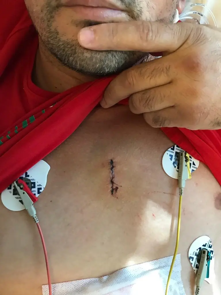 Kalp Ameliyatı Sonrası İyileşme Süreci