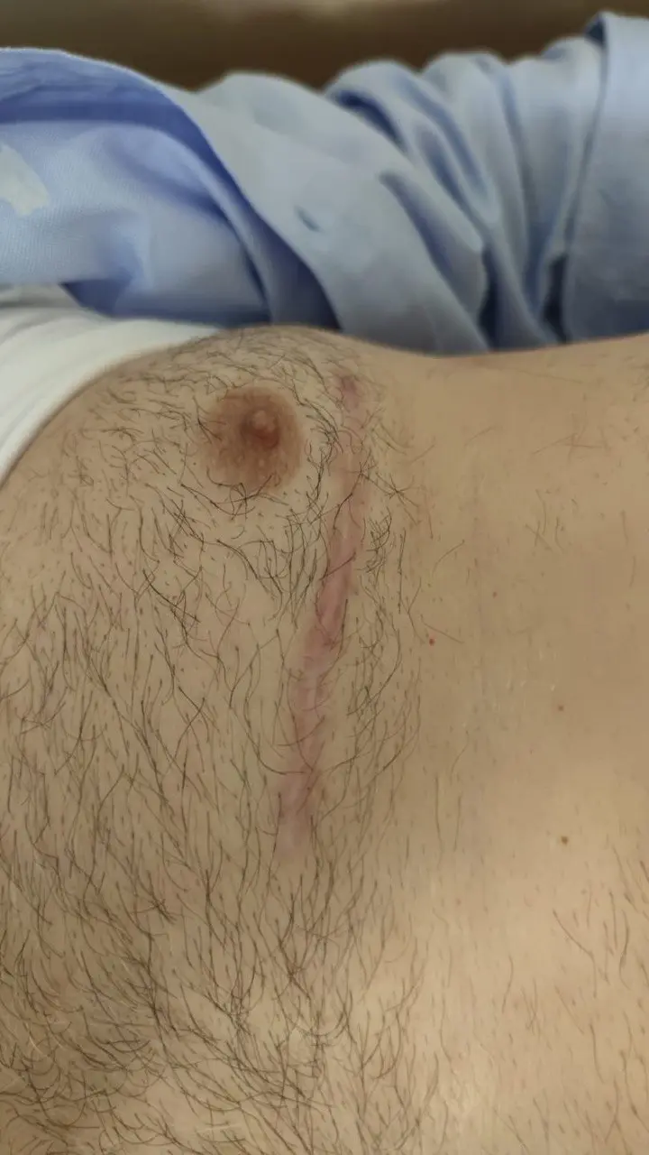 Kapalı Koroner Bypass Ameliyatı: Başarı Oranları ve Sonuçları