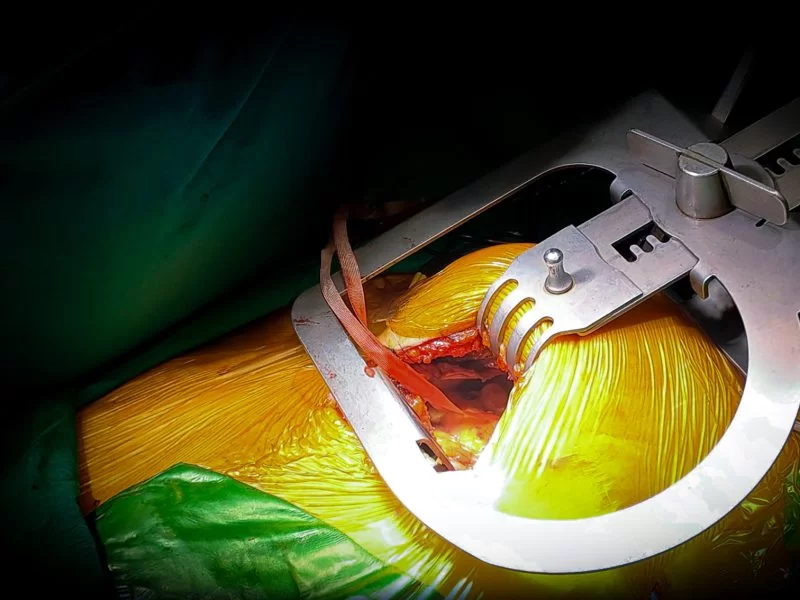 Kapalı Koroner Bypass Ameliyatı: Başarı Oranları ve Sonuçları