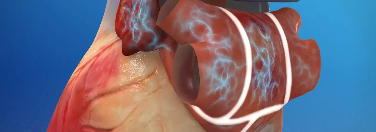 Maze Ameliyatı Nedir? Kimlere Uygulanır?