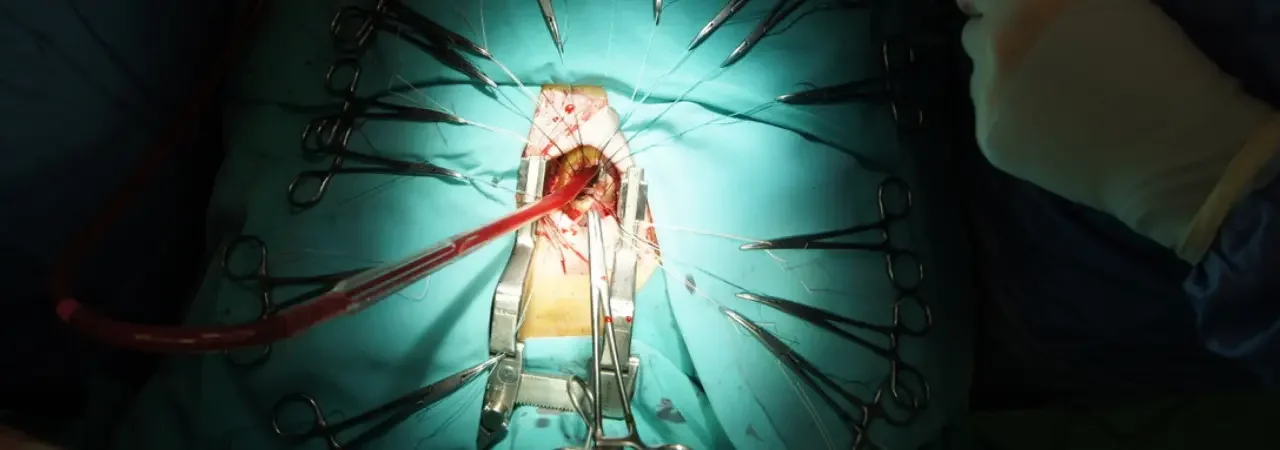 Minimal İnvaziv Kapak Ameliyatı: Düşük Risk, Yüksek Başarı