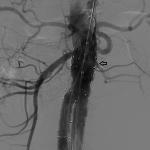 Endovasküler Aortik Greft İmplantasyonu