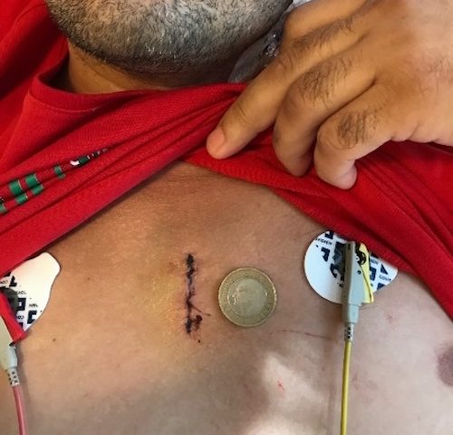Bentall – Aortenwurzelchirurgie Kleiner Schnitt „Achselherzchirurgie“