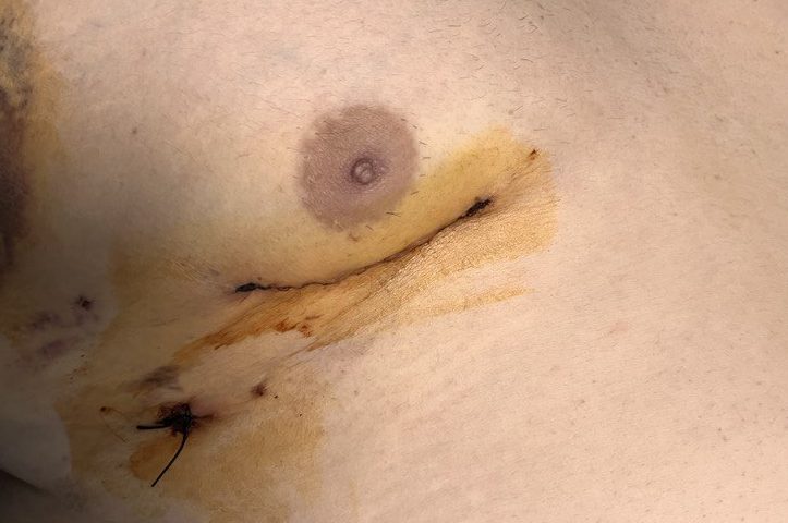 Göğüs kafesi açılmadan kalbin iyi huylu tümörü (mixoma) ameliyatı