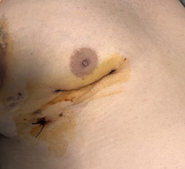 Göğüs kafesi açılmadan kalbin iyi huylu tümörü (mixoma) ameliyatı