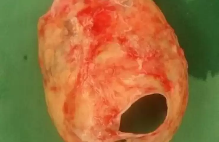 Extrem Sol Atrial Kalsifikasyon (Kalp Kulakçığı Taşlaşması)