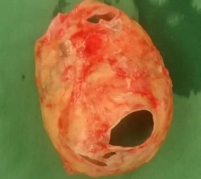 Extrem Sol Atrial Kalsifikasyon (Kalp Kulakçığı Taşlaşması)